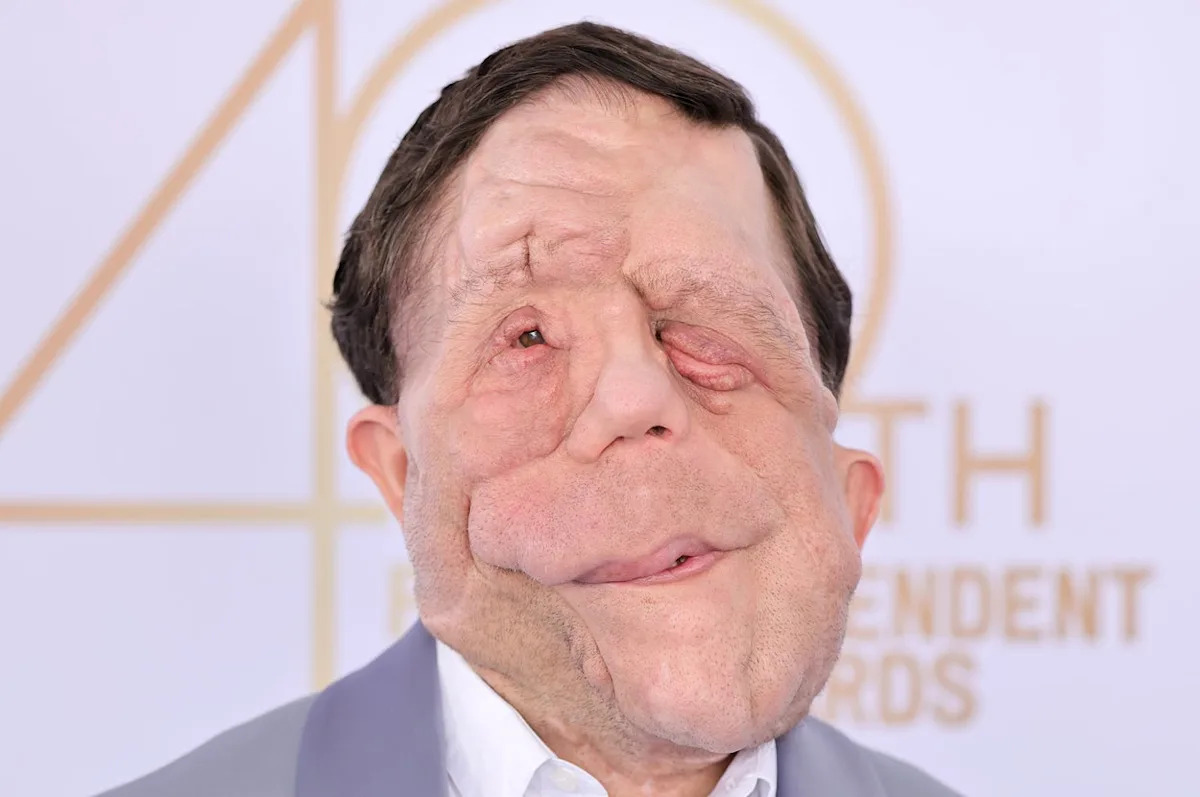 Adam Pearson's Oscars Response: Standing Strong Against Mockery